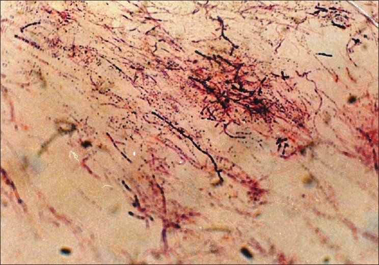 Nocardia Nocardia asteroides